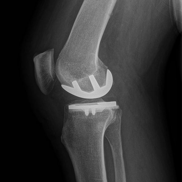 Chirurgie du sportif Croix-Rousse